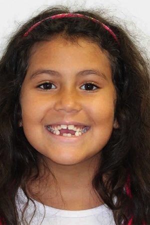 Child with gaps between teeth before orthodontic treatment