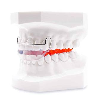 Smile Bionator orthodontic appliance