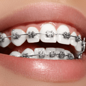 Closeup of teeth with self-ligating braces