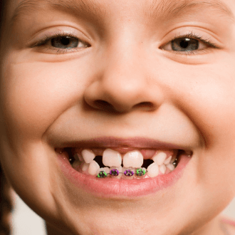 Closeup of smile with pediatric orthdoontic appliance in place