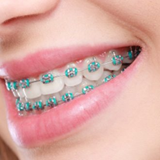 Closeup of girl with blue braces smiling