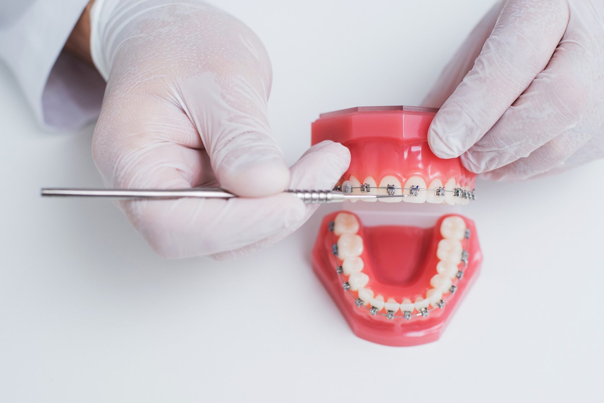 Traditional vs. Self-Ligating Braces | Simply Orthodontics